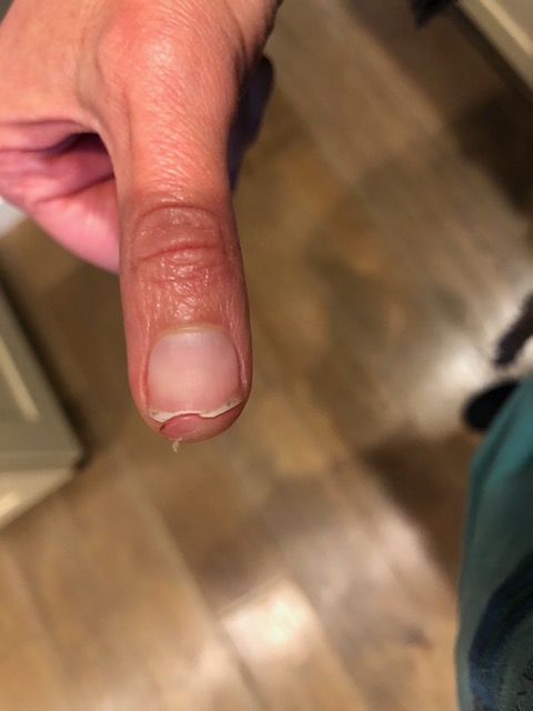 My thumb is pretty well healed!  The nail has grown out too