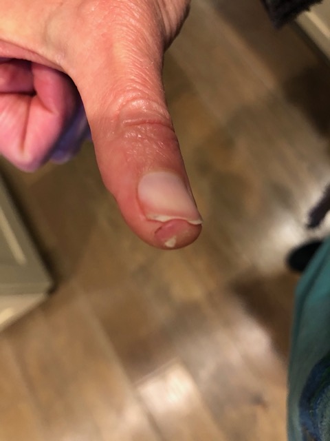 The original cut went halfway through the pink part of the nail