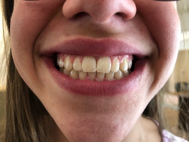 Closeup of her teeth