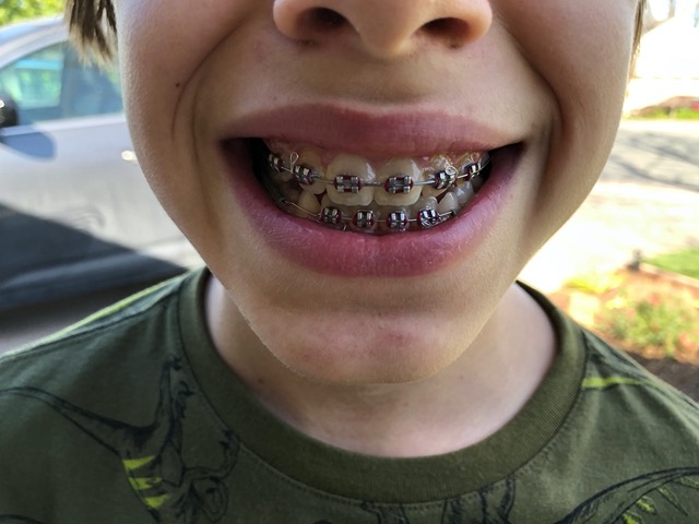 Owen right before getting his braces off