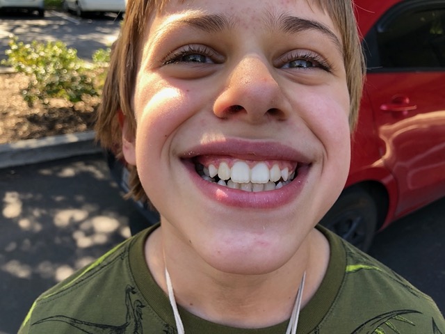 Braces are finally OFF