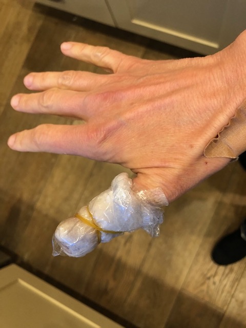 Cut my thumb through to the bone.  Here it is all bandaged.
